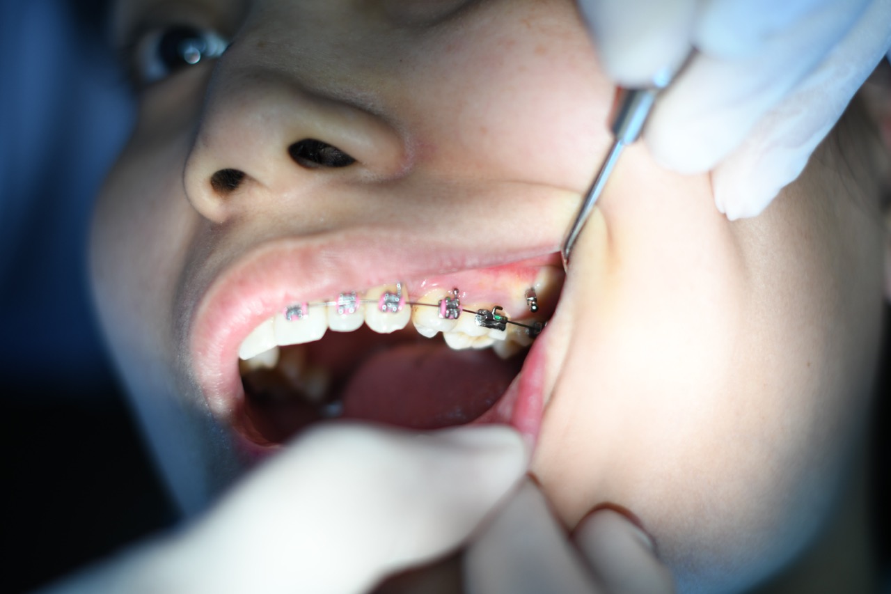can a dentist tell if you vape How to refill alfakher crown bar main image 1